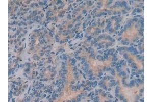 Detection of b2M in Human Thyroid cancer Tissue using Polyclonal Antibody to Beta-2-Microglobulin (b2M)