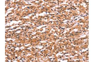 The image on the left is immunohistochemistry of paraffin-embedded Human thyroid cancer tissue using ABIN7190731(GABRA1 Antibody) at dilution 1/30, on the right is treated with synthetic peptide.
