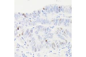 Immunohistochemistry of paraffin-embedded human colon carcinoma using [KO Validated] p53 Rabbit mAb (ABIN7271080) at dilution of 1:100 (40x lens).