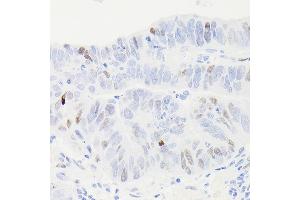 Immunohistochemistry of paraffin-embedded human colon carcinoma using [KO Validated] p53 Rabbit mAb (ABIN7271080) at dilution of 1:100 (40x lens). (p53 anticorps)