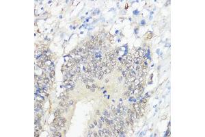 Immunohistochemistry of paraffin-embedded human colon carcinoma using GPX2 antibody (ABIN7267435) at dilution of 1:100 (40x lens).