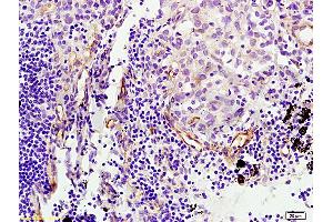 Formalin-fixed and paraffin embedded human melanoma tissue labeled with Anti-CD105 Polyclonal Antibody (ABIN707561), Unconjugated at 1:200 followed by conjugation to the secondary antibody, (SP-0023), and DAB staining