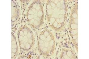 Immunohistochemistry of paraffin-embedded human colon cancer using ABIN7176692 at dilution of 1:100 (SLC39A7 anticorps  (AA 235-380))