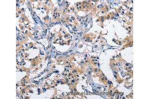Immunohistochemistry of Human thyroid cancer using CLEC2D Polyclonal Antibody at dilution of 1:60 (CLEC2D anticorps)