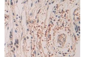 Detection of SHC3 in Human Stomach cancer Tissue using Polyclonal Antibody to SHC-Transforming Protein 3 (SHC3)