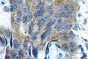 Immunohistochemistry (IHC) analyzes of p-Catenin-beta antibody in paraffin-embedded human colon carcinoma tissue. (CTNNB1 anticorps  (pSer33))