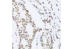 Immunohistochemistry of paraffin-embedded human breast cancer using NFKB2 Antibody.