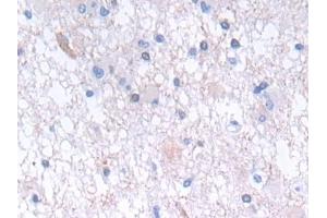 Detection of GLTP in Human Glioma Tissue using Polyclonal Antibody to Glycolipid Transfer Protein (GLTP)