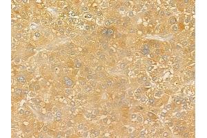 ABIN6258625 and ABIN6275893 at 1/100 staining human hepatocellular carcinoma by IHC-P. (CPA anticorps  (Internal Region))