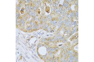 Immunohistochemistry of paraffin-embedded human colon carcinoma using PSG1 antibody (ABIN5973801) at dilution of 1/100 (40x lens). (PSG1 anticorps)