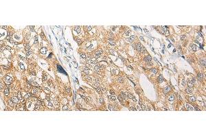 Immunohistochemistry of paraffin-embedded Human gastric cancer tissue using RGN Polyclonal Antibody at dilution of 1:25(x200)