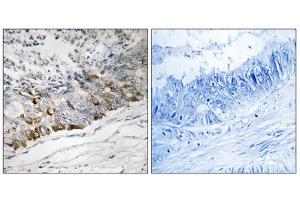 Immunohistochemistry analysis of paraffin-embedded human colon carcinoma tissue using GCHFR antibody. (GCHFR anticorps  (Internal Region))