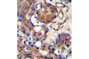 Immunohistochemistry analysis in formalin fixed and paraffin embedded human breast carcinoma reacted with Kininogen-1 Antibody (N-term) followed which was peroxidase conjugated to the secondary antibody and followed by DAB staining. (KNG1 anticorps  (N-Term))