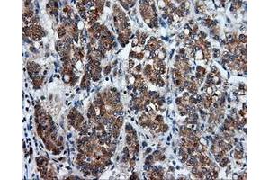 Immunohistochemical staining of paraffin-embedded Carcinoma of liver tissue using anti-PSMC3 mouse monoclonal antibody. (PSMC3 anticorps)