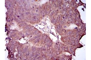 Immunohistochemical analysis of paraffin-embedded rectum cancer tissues using EGFR mutant mouse mAb with DAB staining. (EGFR Mutant (AA 693-893) anticorps)