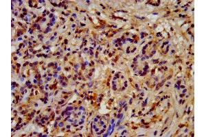 IHC image of ABIN7154923 diluted at 1:200 and staining in paraffin-embedded human pancreatic cancer performed on a Leica BondTM system. (HSP9AB1 (AA 150-355) anticorps)