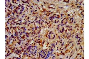 IHC image of ABIN7154923 diluted at 1:200 and staining in paraffin-embedded human pancreatic cancer performed on a Leica BondTM system.
