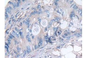 Detection of LIF in Human Colorectal cancer Tissue using Polyclonal Antibody to Leukemia Inhibitory Factor (LIF)