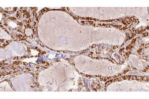 ABIN6267203 at 1/100 staining Human thyroid cancer tissue by IHC-P. (Tuberin anticorps  (pSer1387))