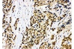 Anti-MCM7 antibody, IHC(P) IHC(P): Human Lung Cancer Tissue