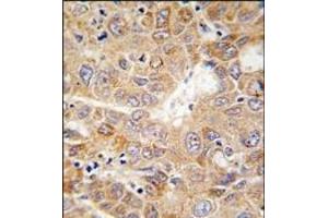 Formalin-fixed and paraffin-embedded human hepatocarcinoma tissue reacted with PGK1 antibody (Center), which was peroxidase-conjugated to the secondary antibody, followed by DAB staining. (PGK1 anticorps  (Middle Region))