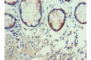 Immunohistochemistry of paraffin-embedded human colon cancer using ABIN7142909 at dilution of 1:100 (AKAP5 anticorps  (AA 1-270))