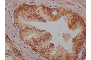 IHC image of ABIN7127359 diluted at 1:100 and staining in paraffin-embedded human prostate cancer performed on a Leica BondTM system.