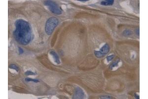 IHC-P analysis of Human Colorectal cancer Tissue, with DAB staining. (GDF11 anticorps  (AA 138-386))