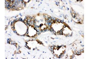 Anti- TMEM173 Picoband antibody, IHC(P) IHC(P): Human Lung Cancer Tissue