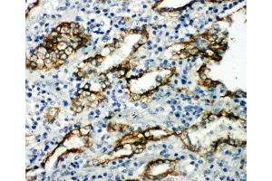 IHC-P: Aquaporin 4 antibody testing of human lung cancer tissue