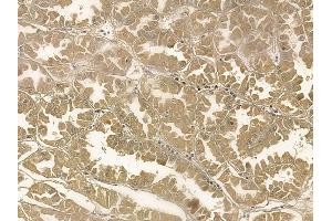 ZFAND3 Mouse Monoclonal Antibody at 1/100 staining human renal cell carcinoma by IHC-P.