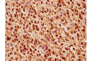 IHC image of ABIN7166287 diluted at 1:200 and staining in paraffin-embedded human glioma performed on a Leica BondTM system. (WIZ anticorps  (AA 1469-1574))