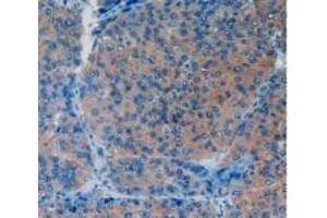 Detection of VCAM1 in Human Liver Cancer Tissue using Polyclonal Antibody to Vascular Cell Adhesion Molecule 1 (VCAM1)