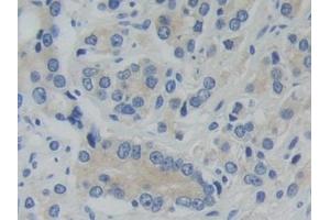 Detection of PFKP in Human Prostate cancer Tissue using Polyclonal Antibody to Phosphofructokinase, Platelet (PFKP)