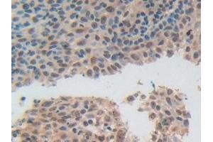 Detection of ADRM1 in Human Skin cancer Tissue using Polyclonal Antibody to Adhesion Regulating Molecule 1 (ADRM1) (ADRM1 anticorps  (AA 2-407))