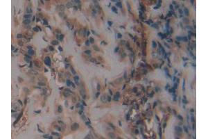 DAB staining on IHC-P; Samples: Human Breast cancer Tissue
