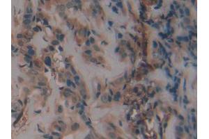 DAB staining on IHC-P; Samples: Human Breast cancer Tissue (PAI1 anticorps  (AA 25-402))