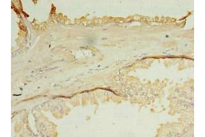 Immunohistochemistry of paraffin-embedded human prostate cancer using ABIN7162127 at dilution of 1:100 (OCIAD1 anticorps  (AA 1-245))