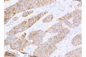 Immunohistochemistry (IHC) image for anti-Receptor tyrosine-protein kinase erbB-2 (ErbB2/Her2) (AA 1205-1255) antibody (ABIN7455181) (Recombinant ErbB2/Her2 anticorps  (AA 1205-1255))