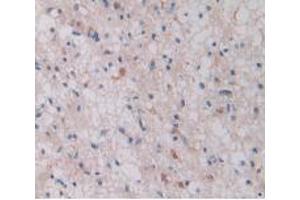 IHC-P analysis of Human Glioma Tissue, with DAB staining. (ITGB1 anticorps  (AA 140-383))