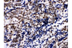 Anti- KU80 Picoband antibody,IHC(P) IHC(P): Human Lung Cancer Tissue