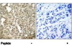 Immunohistochemical analysis of paraffin-embedded human breast carcinoma tissue using PRKCD polyclonal antibody  . (PKC delta anticorps)