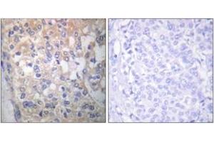 Immunohistochemistry analysis of paraffin-embedded human breast carcinoma, using Fyn (Phospho-Tyr530) Antibody.