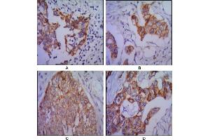 Immunohistochemical analysis of paraffin-embedded human lung cancer (A), colon cancer (B), ovarian cancer (C) and mammary cancer(D), using CDH2 mouse mAb with DAB staining.