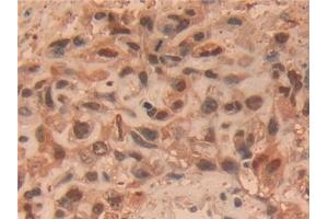 Detection of UCHL1 in Human Lung cancer Tissue using Polyclonal Antibody to Ubiquitin Carboxyl Terminal Hydrolase L1 (UCHL1)