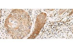 Immunohistochemistry of paraffin-embedded Human esophagus cancer tissue using EXD2 Polyclonal Antibody at dilution of 1:55(x200) (EXD2 anticorps)
