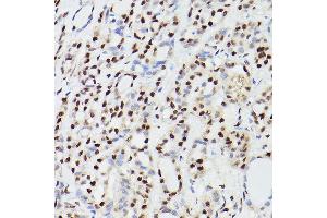 Immunohistochemistry of paraffin-embedded human thyroid cancer using CPSF6 Rabbit pAb (ABIN6128924, ABIN6138974, ABIN6138975 and ABIN6221646) at dilution of 1:100 (40x lens).