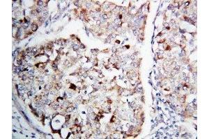 IHC-P: MEK1 antibody testing of human lung cancer tissue (MEK1 anticorps  (C-Term))