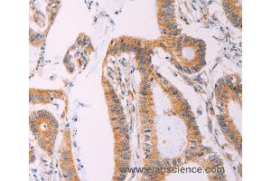 Immunohistochemistry of Human liver cancer using ADCY1 Polyclonal Antibody at dilution of 1:60 (ADCY1 anticorps)