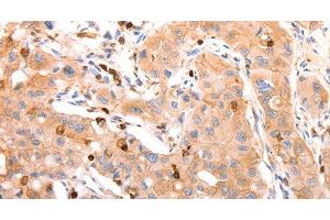 Immunohistochemistry of paraffin-embedded Human lung cancer tissue using CELSR2 Polyclonal Antibody at dilution 1:50 (CELSR2 anticorps)